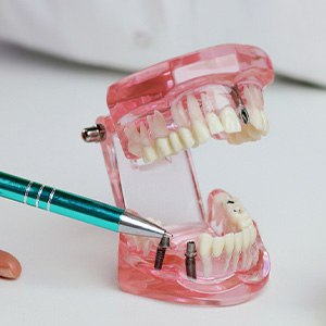 Dentist pointing to model of dental implant