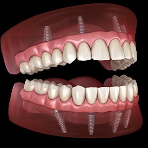 Illustration of all-on-4 dentures
