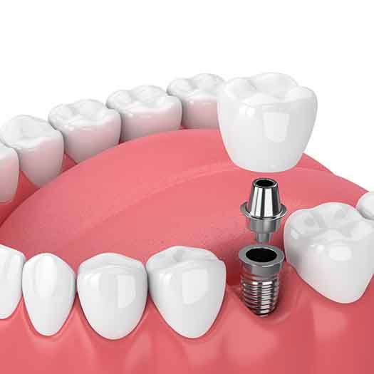The dental implant process can be done in four main steps.