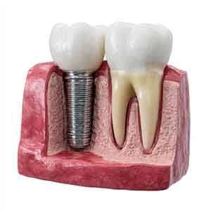 Osseointegration is an important part of the dental implant process