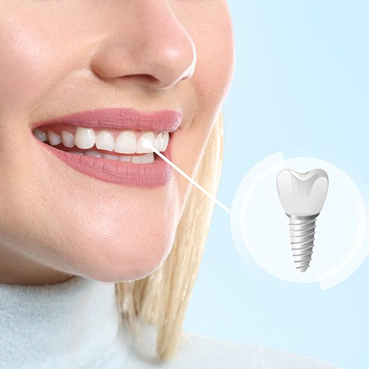 a 3D illustration of a dental implant