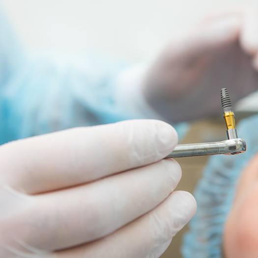 a closeup of a dentist holding a dental implant before placement