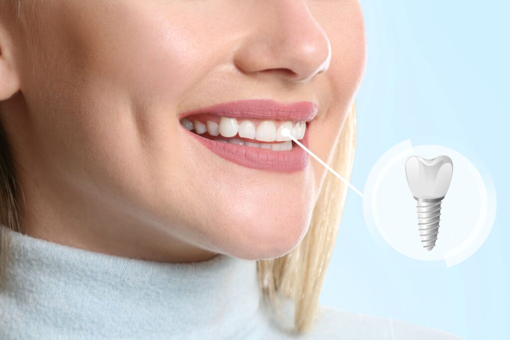 Nose-down view of woman smiling with front tooth indicated as implant